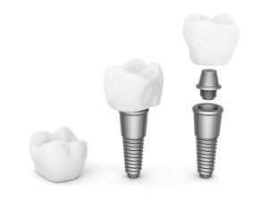 Tipo de implante dental que se puede utilizar