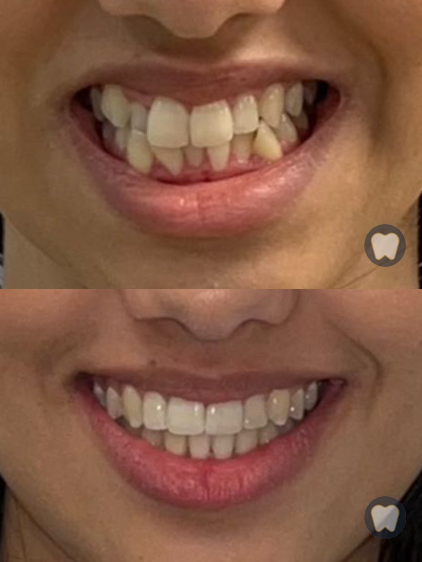 resultados ortodoncia con brackets