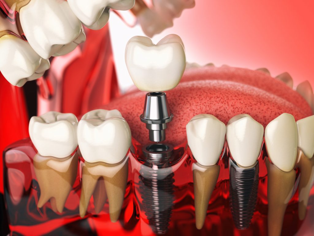 Riesgos de los implantes dentales