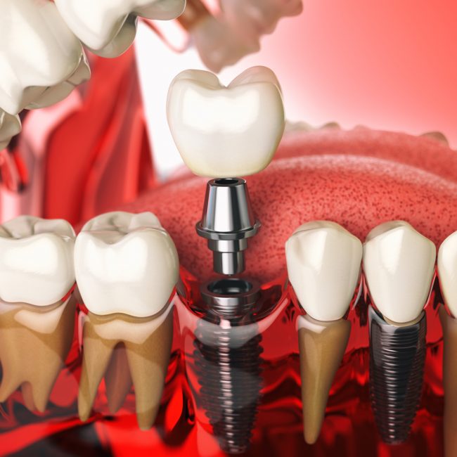 Riesgos de los implantes dentales