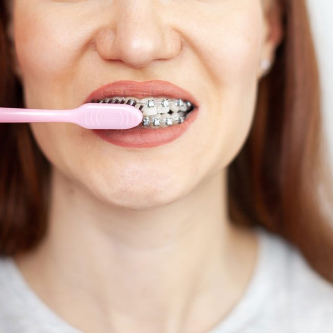 Guía para realizar un buen cepillado dental con brackets
