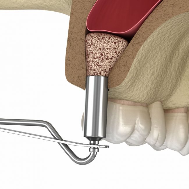 Elevación seno maxilar