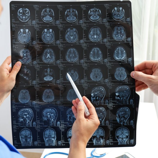 causas del Alzheimer