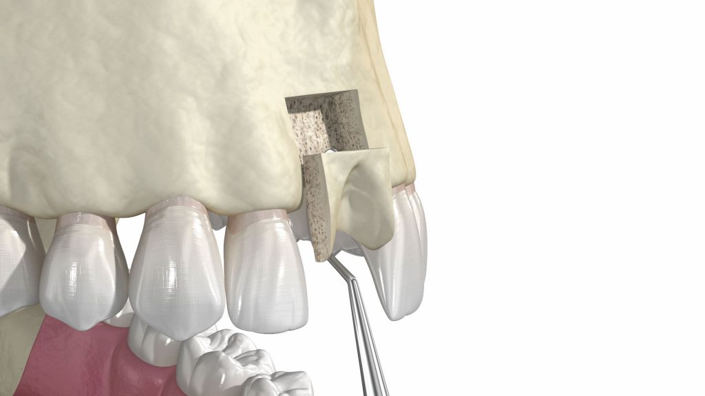pérdida de hueso dental