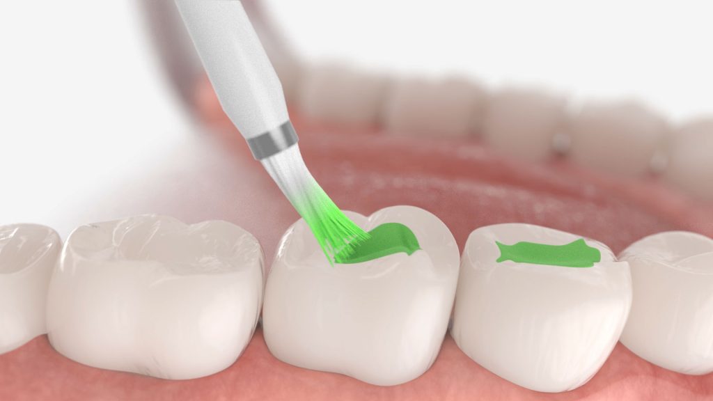 sellado de fisura dental