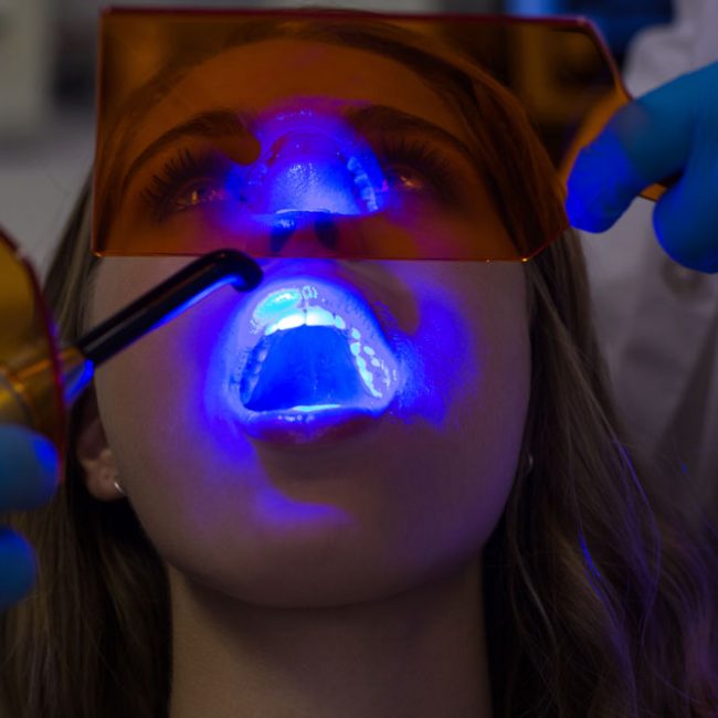 errores blanqueamiento dental