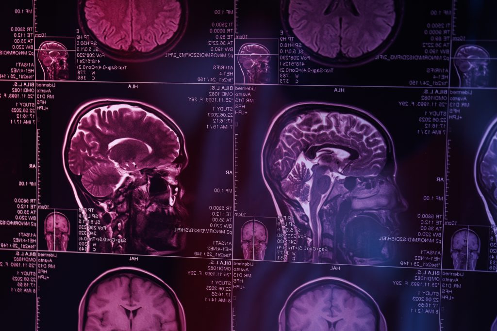 Periodontitis y Alzheimer