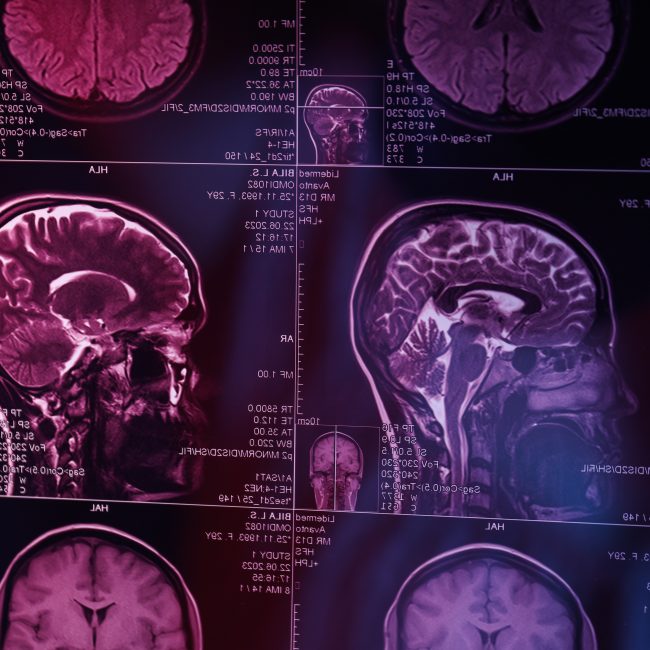 Periodontitis y Alzheimer