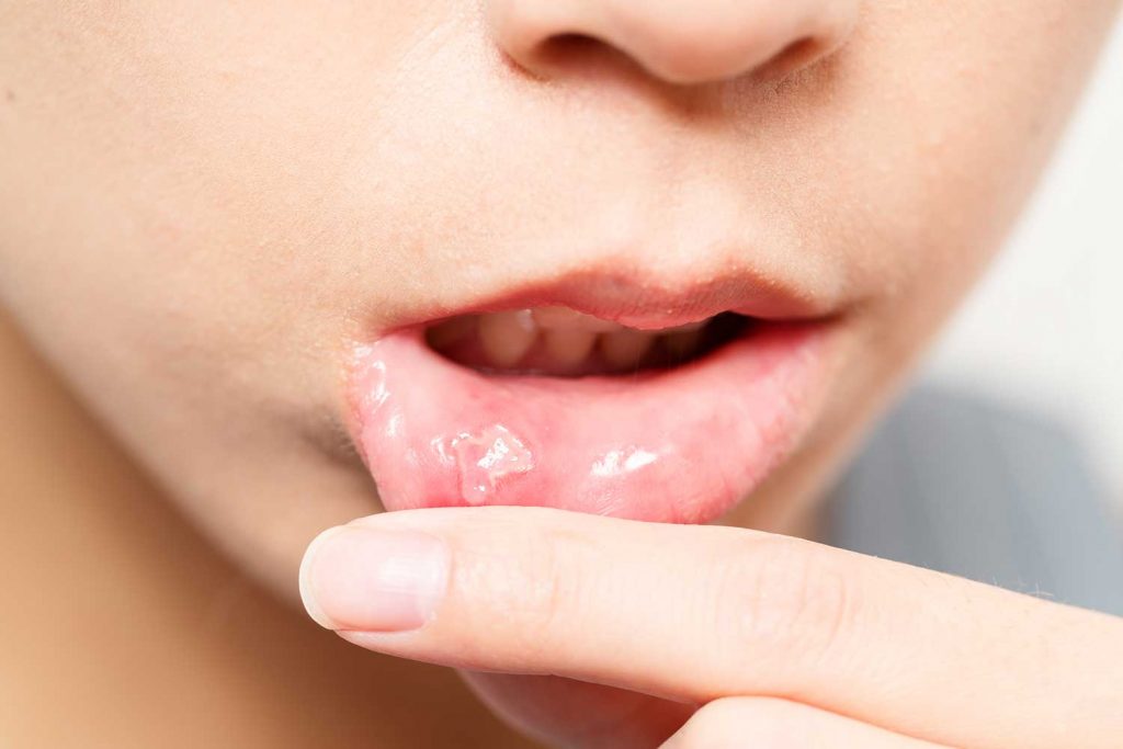 el estrés afecta a los dientes