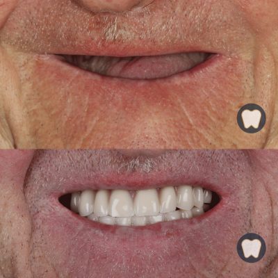 Implantología y prótesis dentales