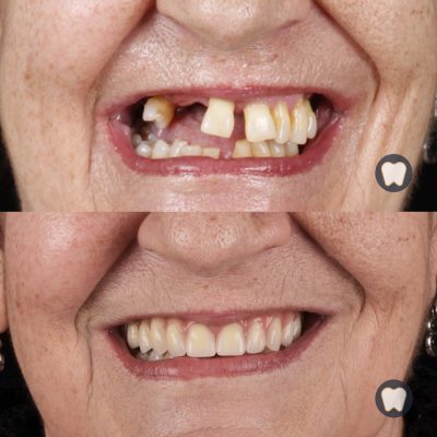 Implantes dentales y prótesis