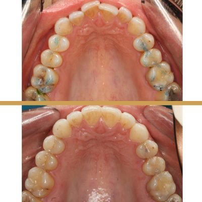 cas-ortodoncia-invisalign