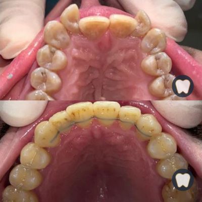 Ortodoncia metálica
