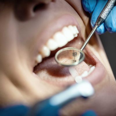 Ortodoncia Lingual en LLeida