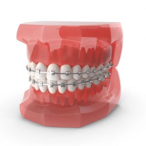 ortodoncia con brackets