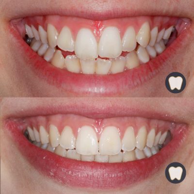 ortodoncia-somriure
