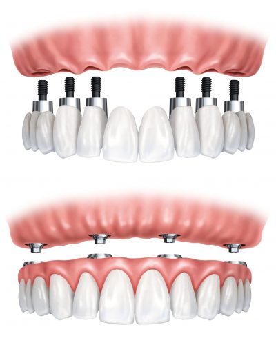 Implantes Dentales Lleida