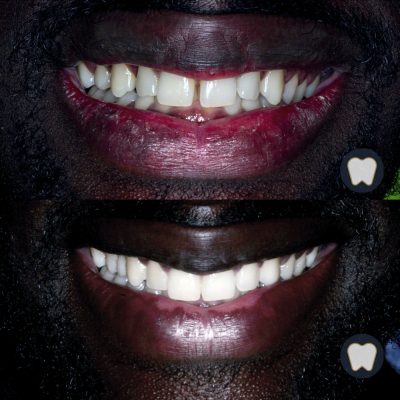 Reconstrucción dental