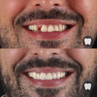 Rehabilitació dental